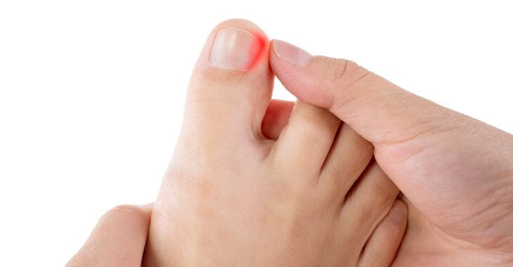 a person looking closely at their ingrown toenail