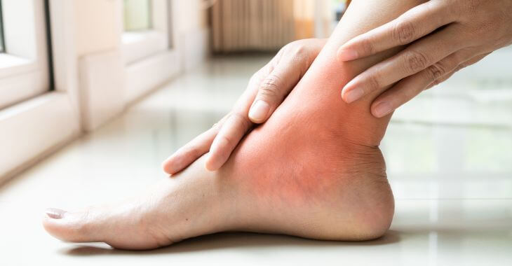 Woman with a purple skin around her ankle looking closely and touching skin around the discolored area