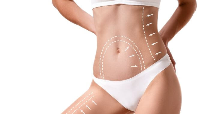 Body of a slim woman with arrows showing lipo 360 treatment area