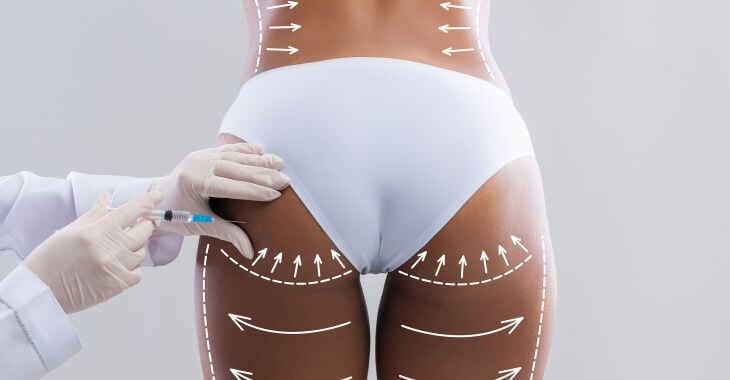 a rare view of woman's back buttock and thighs with arrows showing body contouring procedures results