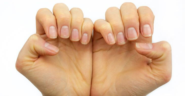 nails with white spots caused by keratin granulation