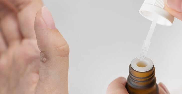 A woman using beetle juice for a wart on her finger